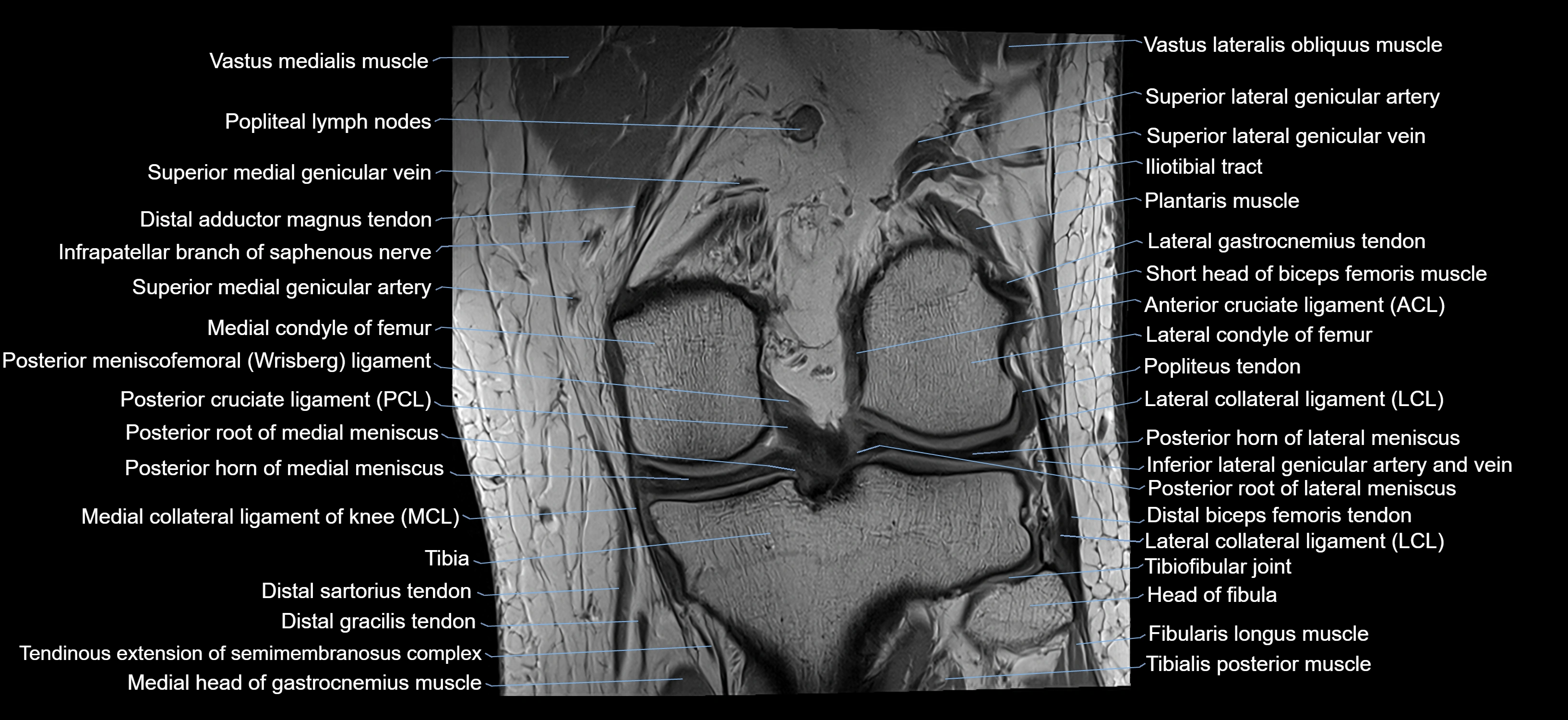 MRI knee coronal cross sectional anatomy labelled 3T radiology  image-04001-00025.webp